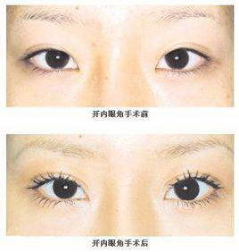 天津双眼皮手术哪个医院比较好