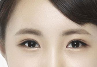 武汉双眼皮价格：了解双眼皮术的性价比