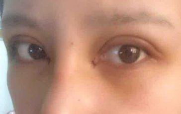 以双眼皮开眼角的每日清洁护理_双眼皮开眼角不一样图片