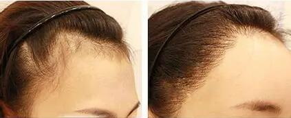 加密头发和植发的区别