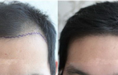 疤痕种植眉毛成活率