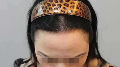 女人头顶头发稀少原因