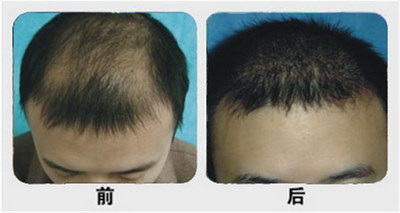 武汉植发机构：安全、高效、给你最贴心的植发服务
