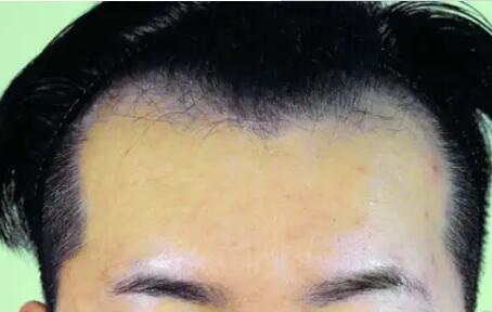 植发对头发有什么副作用
