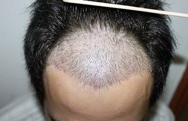 疤痕植发有哪些适应症_疤痕植发能成功吗