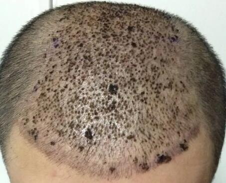 局部秃头是什么原因导致的_头顶螺旋处头发少会不会秃头