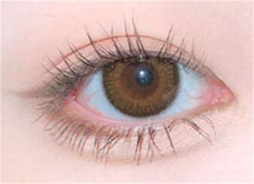 双眼皮手术优缺点是什么